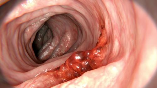 Ansicht eines sauberen Dickdarms mit einem kolorektalen Karzinom im Vordergrund. Foto: Darmkrebsvorsorge Graubünden